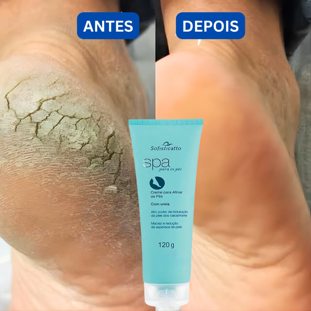 Creme spa dos pés para pé rachado pele ressecada Cotovelo Grosso Joelho Grosso Ureia Pedreiro